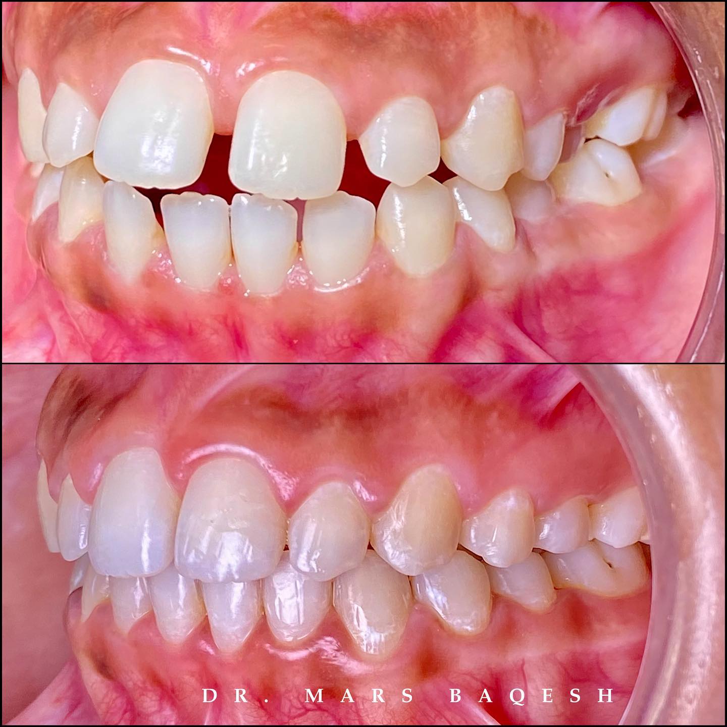 Orthodontic braces wire adjustment & crowding correction progress. Aligning teeth into a harmonious, confident smile arch. 😬✨